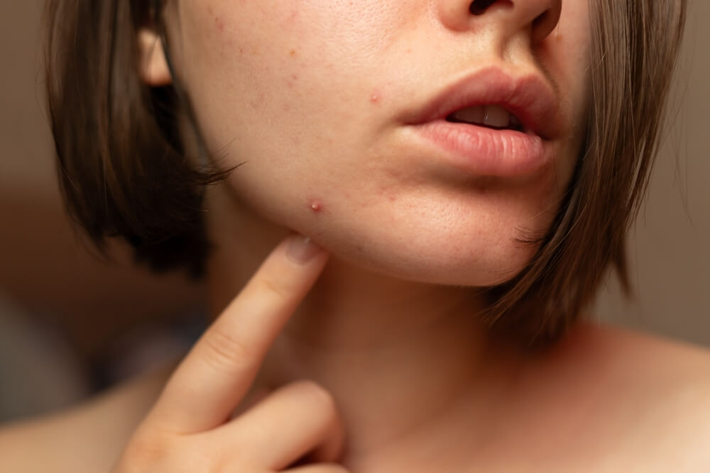 woman hormonal acne